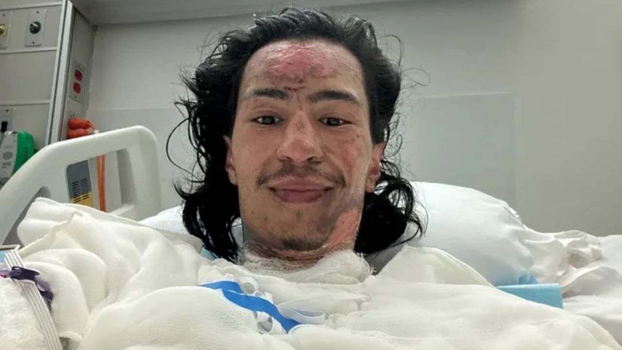Solana Developer Suffers Severe Burns In Stunt For Meme Coin